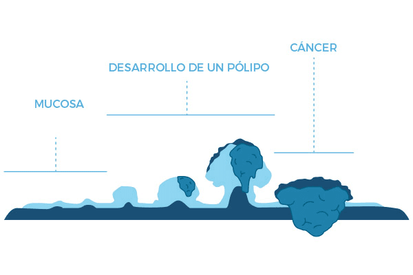 Evolución de la mucosa del colon: desarrollo de un pólipo y cáncer
